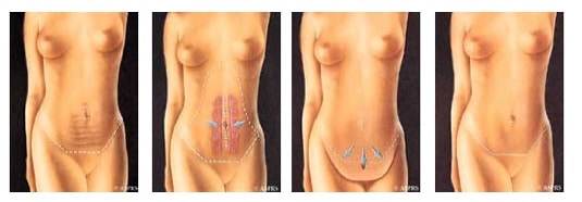 Mini Tummy Tuck Results- Dallas Mommy Makeover Surgeon- Dr. John
