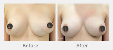 Before and After Image of Breast Revision Dallas TX