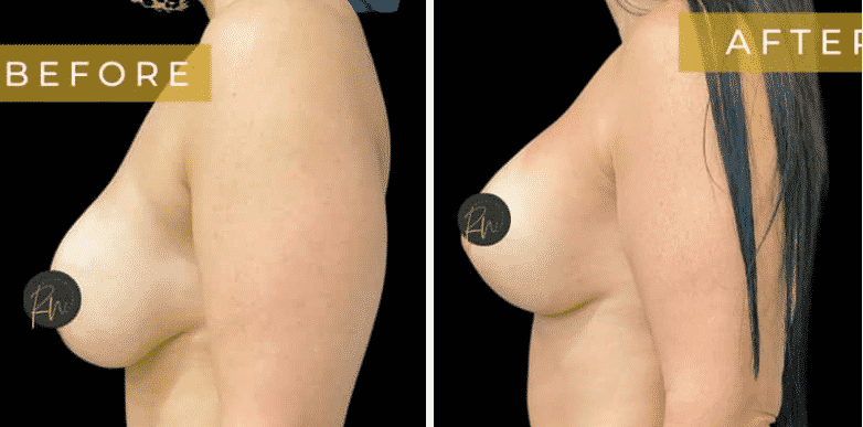 Before and After Image of Breast Correction Dallas TX