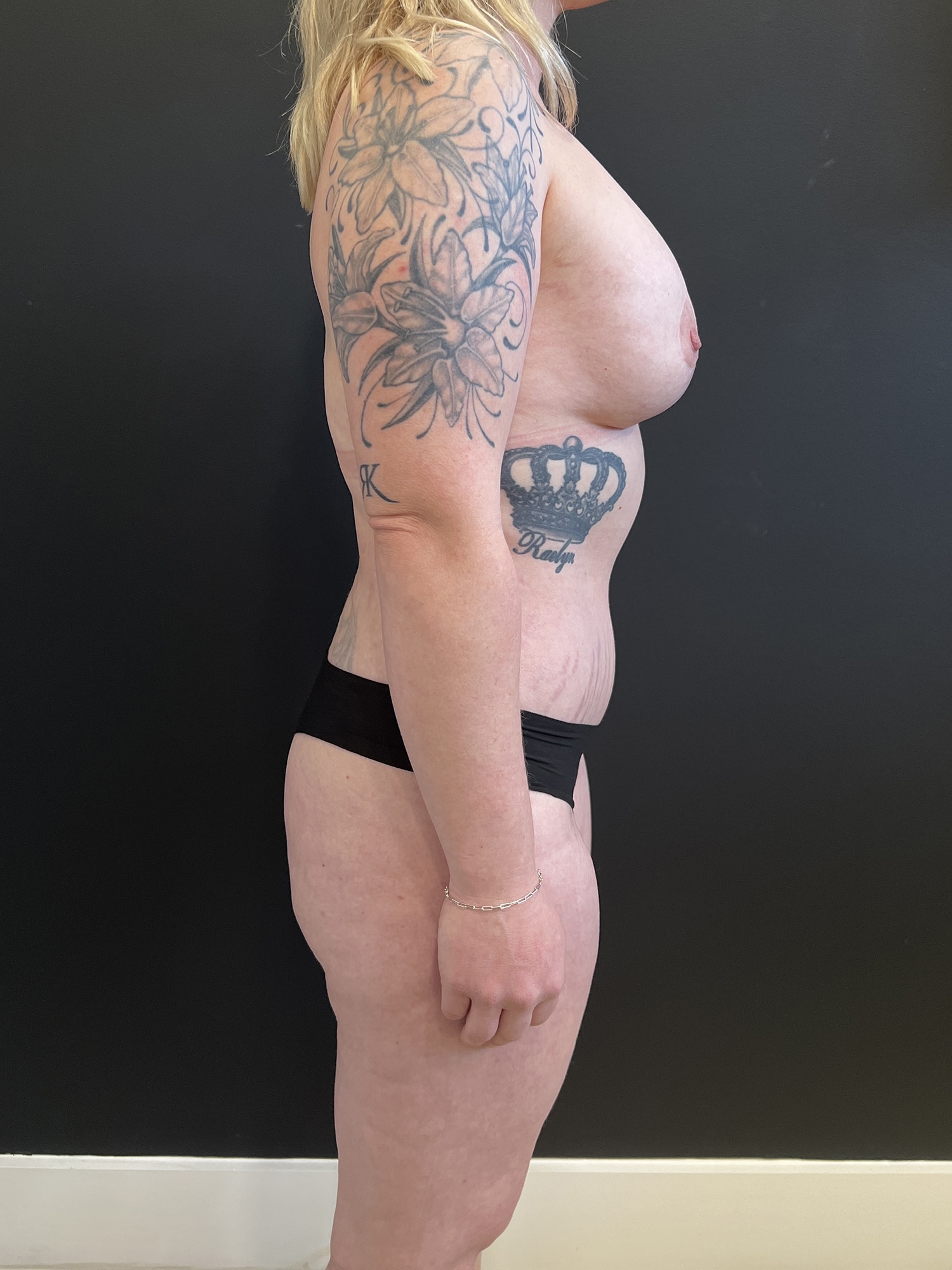 After Image: Case #8149 – Mommy Makeover - right-side