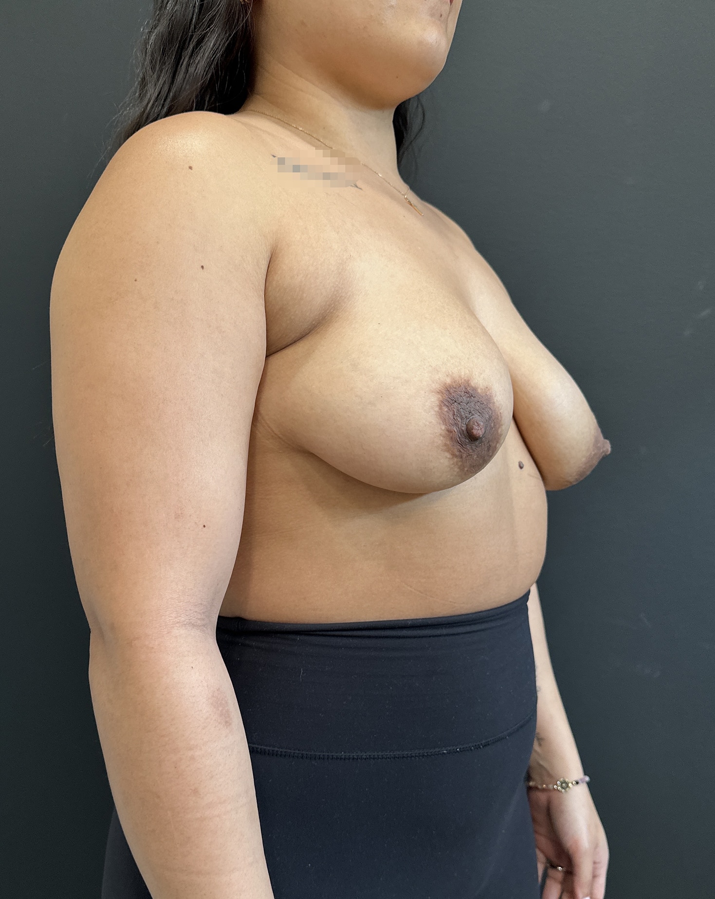 Before Image: Case #8177 – Breast Augmentation - right-front-oblique