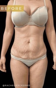Before Image: Case #6722 – Abdominoplasty - front