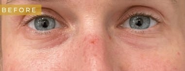 Before Image: Case #7048 – Eyelid Surgery - front