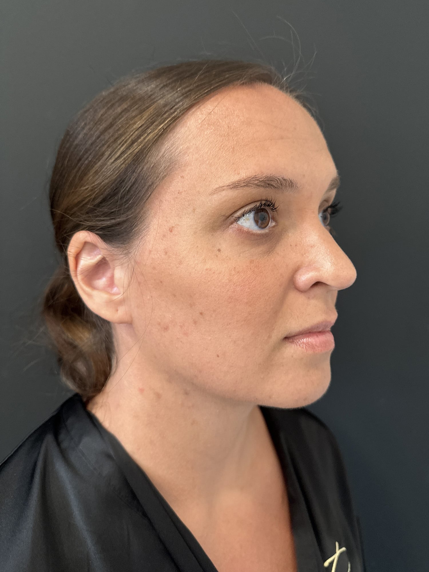 After Image: Case #8248 – Mommy Makeover, SAFELipo of Neck, Breast Aug w/ Lift - right-front-oblique