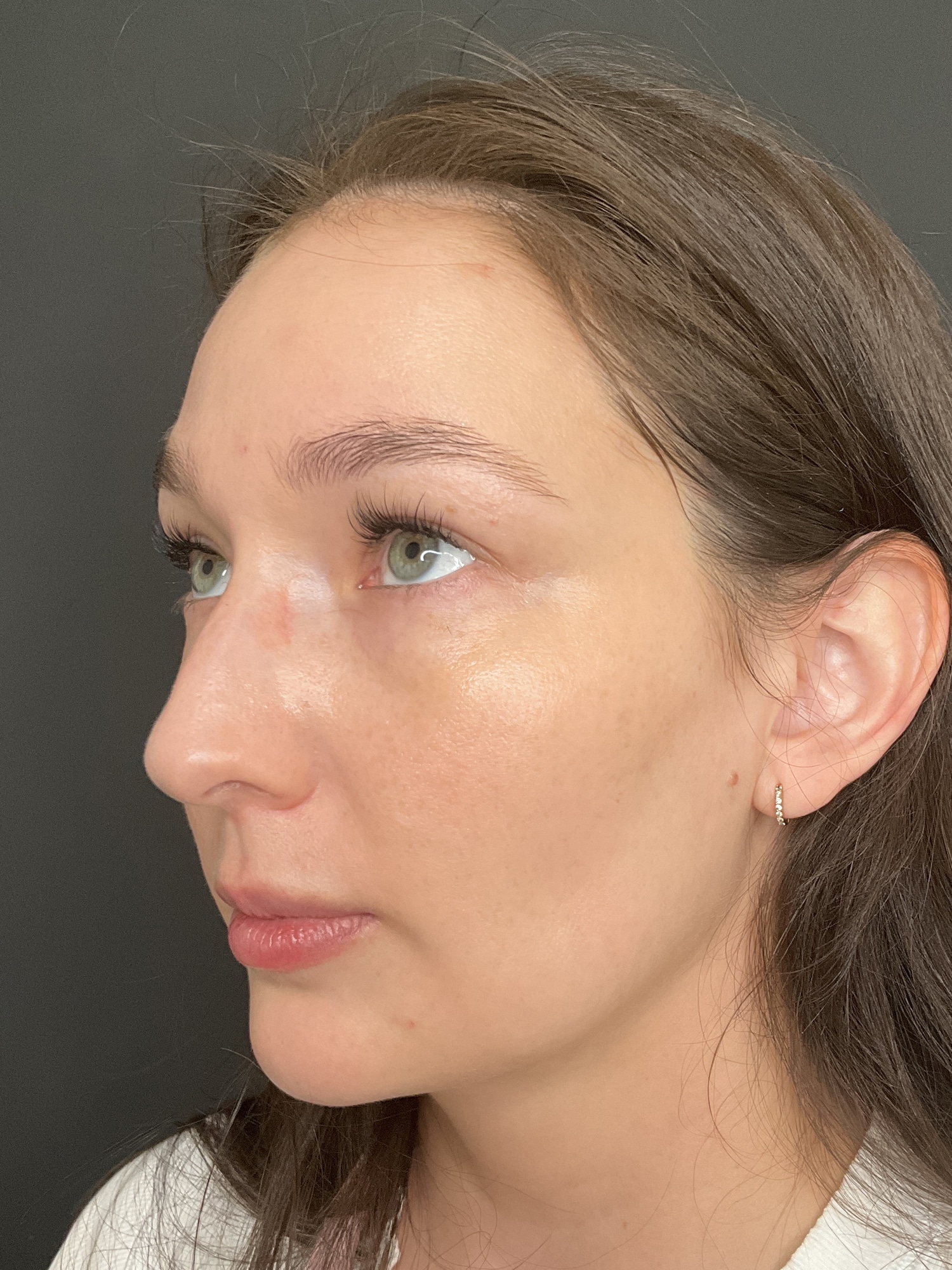After Image: Case #8373 – SAFELipo of neck, buccal fat removal, Sciton BBL Treatment - left-front-oblique