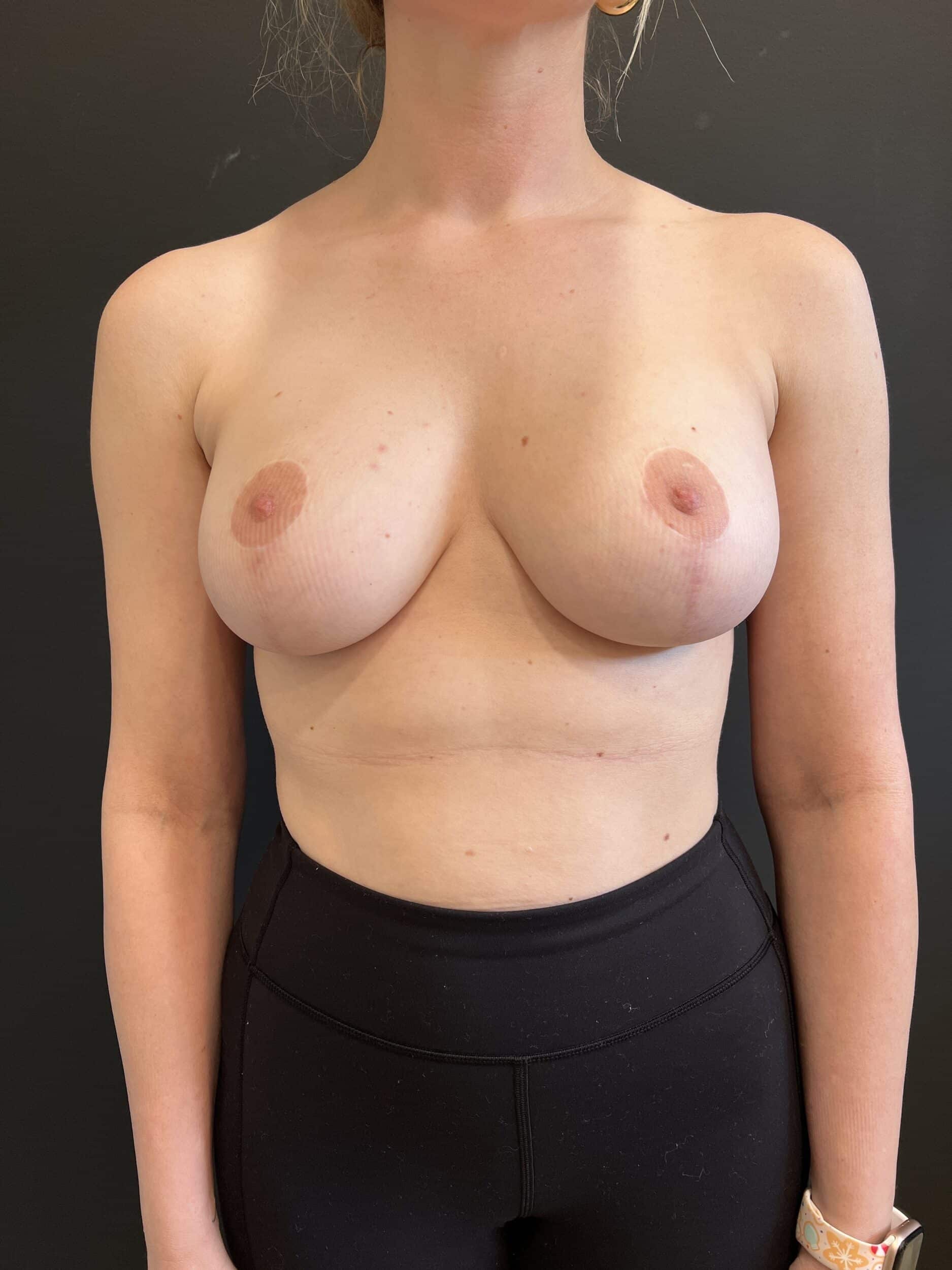 After Image: Case #8515 – Breast Lift with Augmentation - front