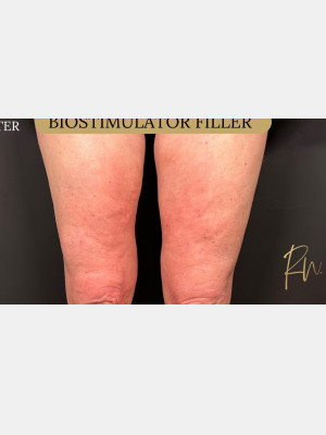 Biostimulator Filler to legs, RN