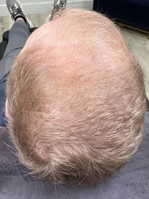 Hair Restoration