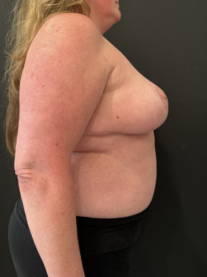 Case #8103 – Breast Reduction, Liposuction