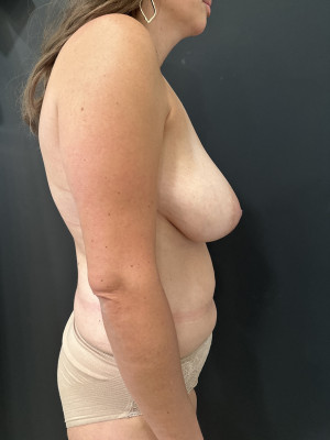 Case #8131 – Abdominoplasty (Tummy Tuck) with Safelipo of Circ Trunk, Breast Reduction