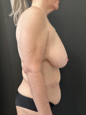 Case #8224 – Mommy Makeover, Tummy Tuck, Breast Reduction