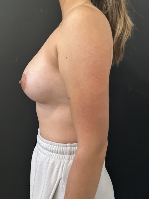 Case #8381 – Breast Asymmetry, Breast Augmentation, Mastopexy, Mastopexy Augmentation