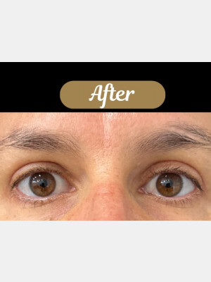 Case #8392 –  Upper Blepharoplasty