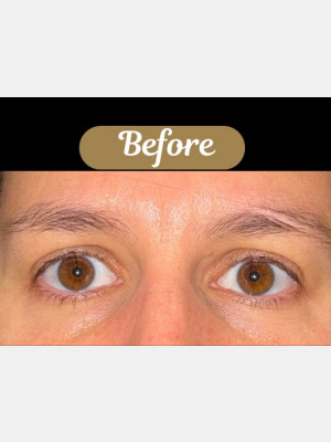 Case #8392 –  Upper Blepharoplasty