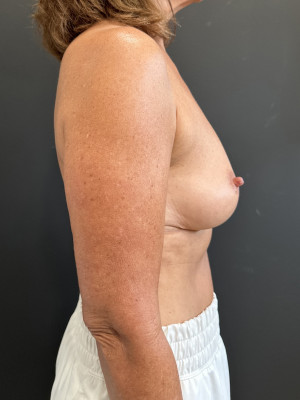 Case #8429 – Breast Augmentation