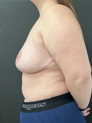 Case #8437 – Breast Reduction, Breast Asymmetry