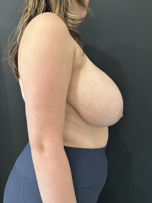 Case #8502 – Breast Reduction, Breast Asymmetry