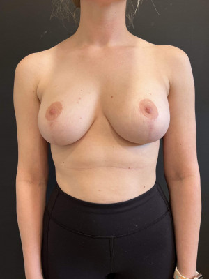 Case #8515 – Breast Lift with Augmentation