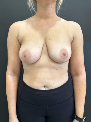 Case #8515 – Breast Lift with Augmentation