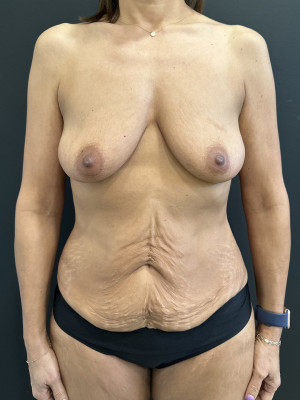 Case #8554 – Abdominoplasty with safelipo sculpting of trunk, breast augmentation with lift